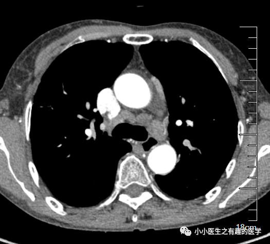 有趣病例肺癌患者縱隔淋巴結腫大不一定是轉移