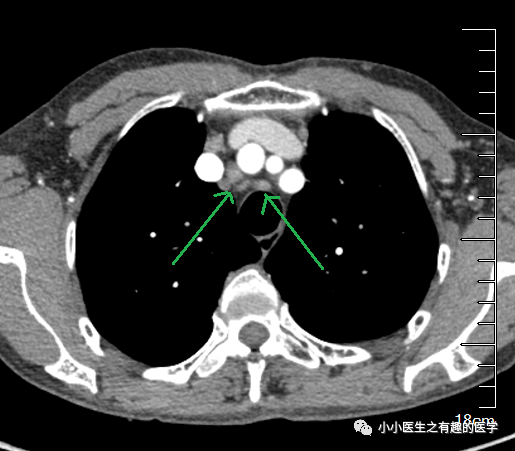 有趣病例肺癌患者縱隔淋巴結腫大不一定是轉移