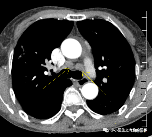 有趣病例肺癌患者纵隔淋巴结肿大不一定是转移
