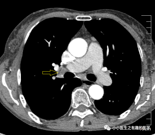 有趣病例肺癌患者縱隔淋巴結腫大不一定是轉移