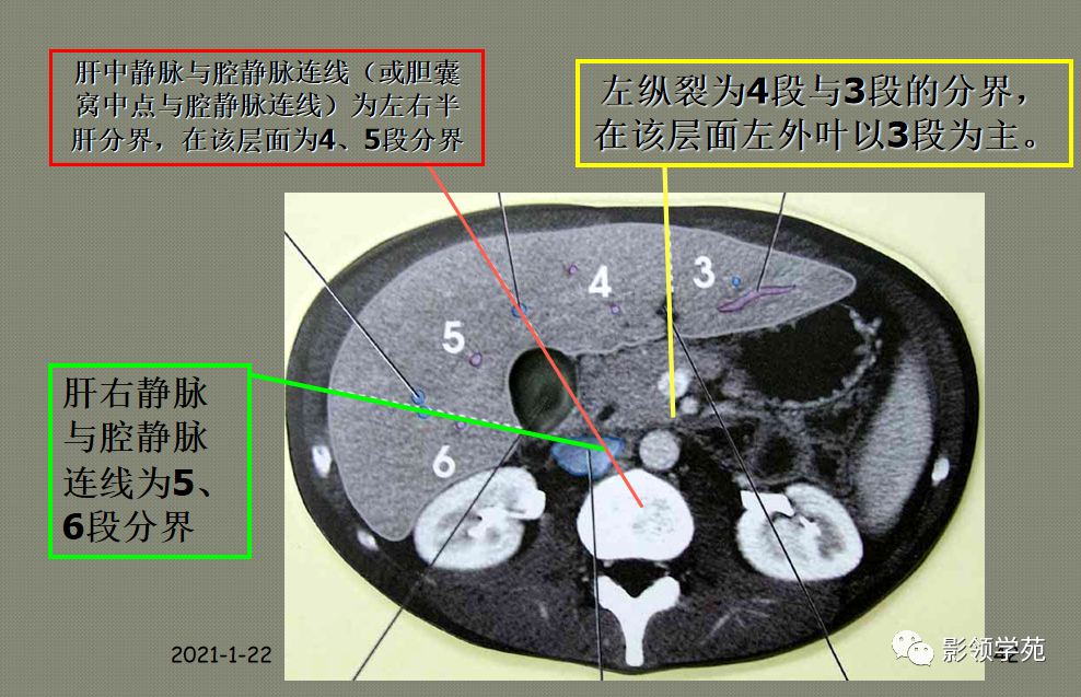 最全总结！肝脏的表面解剖及分叶分段，太赞了_医学界-助力医生临床决策和职业成长