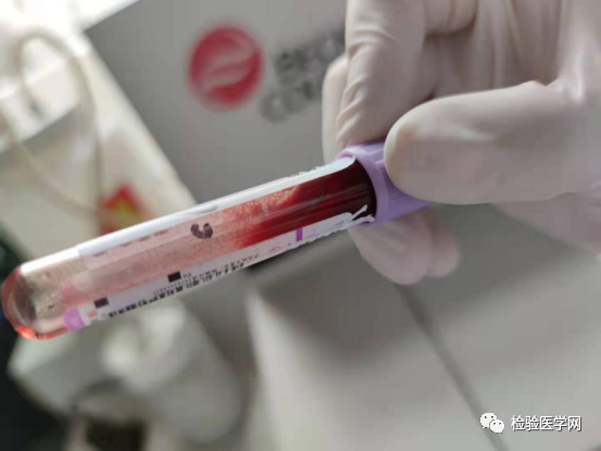 面对一份「高冷」的红细胞凝集标本,你会如何处理?