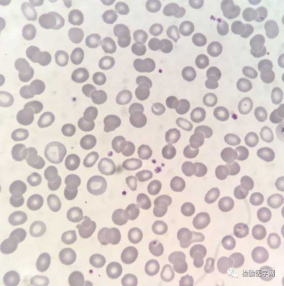 血细胞凝集图图片