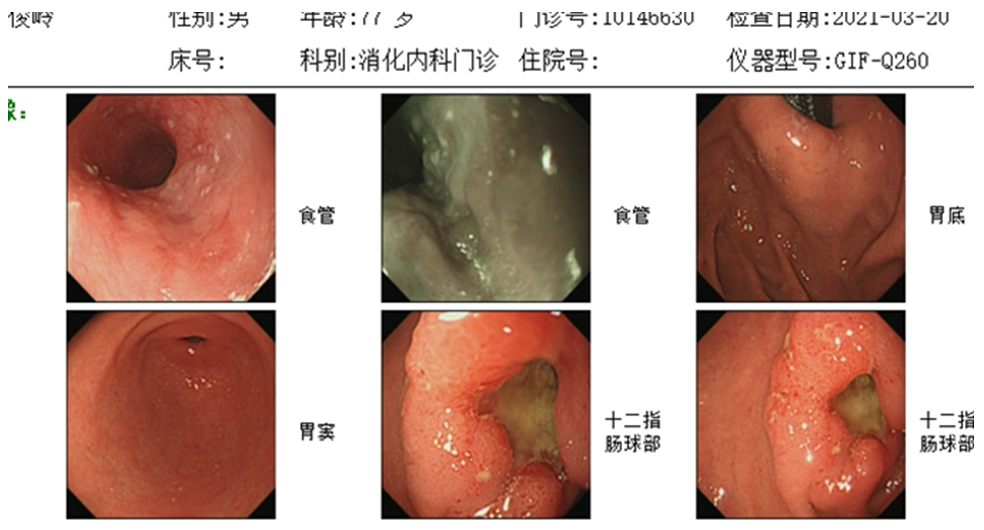 打破傳統觀點注意十二指腸球部潰瘍也有癌變可能