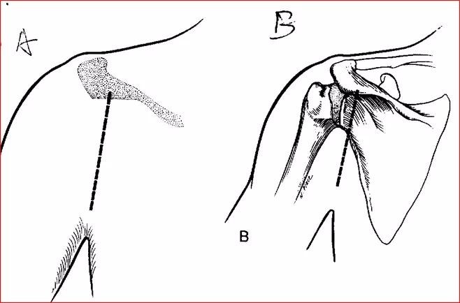 肩胛骨切口入路图片