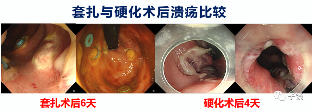 痔疮手术图片过程图片图片