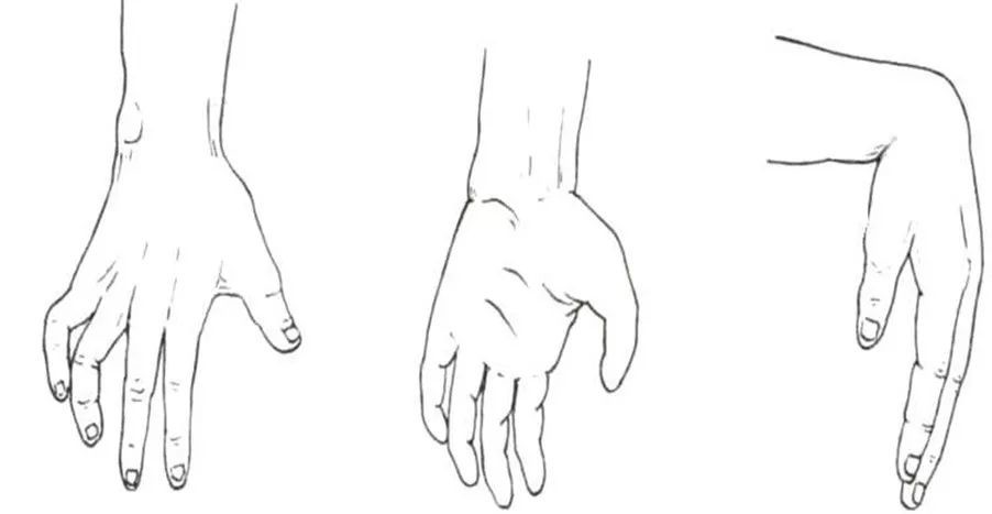 骨科5分钟 腕管综合征的诊断及治疗 医学界 助力医生临床决策和职业成长