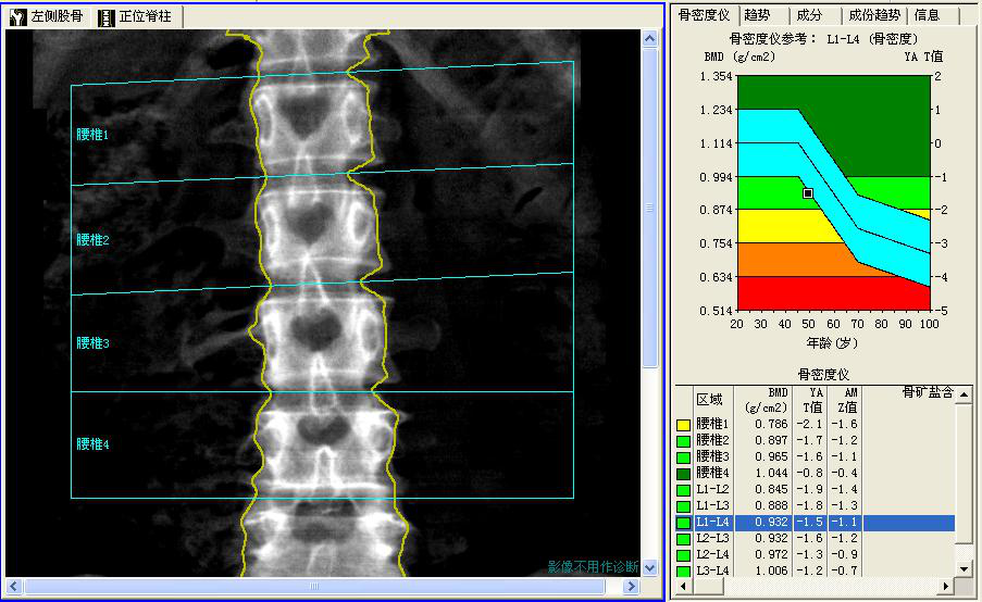 5),髋部骨密度正常(其中股骨颈和总髋部t值均为-0.5),见图1.