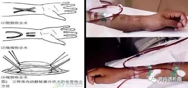 透析患者引起瘙痒的常见原因及应对措施 一文搞定 医学界 助力医生临床决策和职业成长