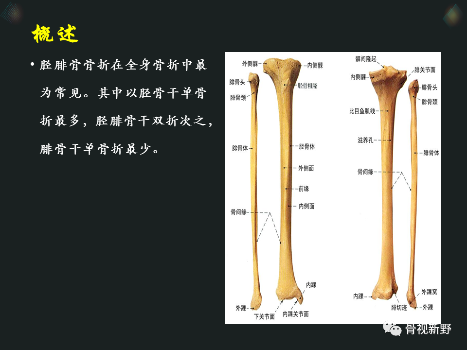 思考 腓骨完整的胫骨中段骨折内固定选择 医学界 助力医生临床决策和职业成长