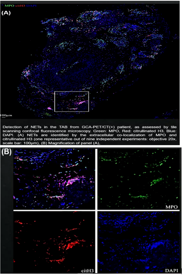 巨细胞动脉炎颞动脉病变部位nets是什么?