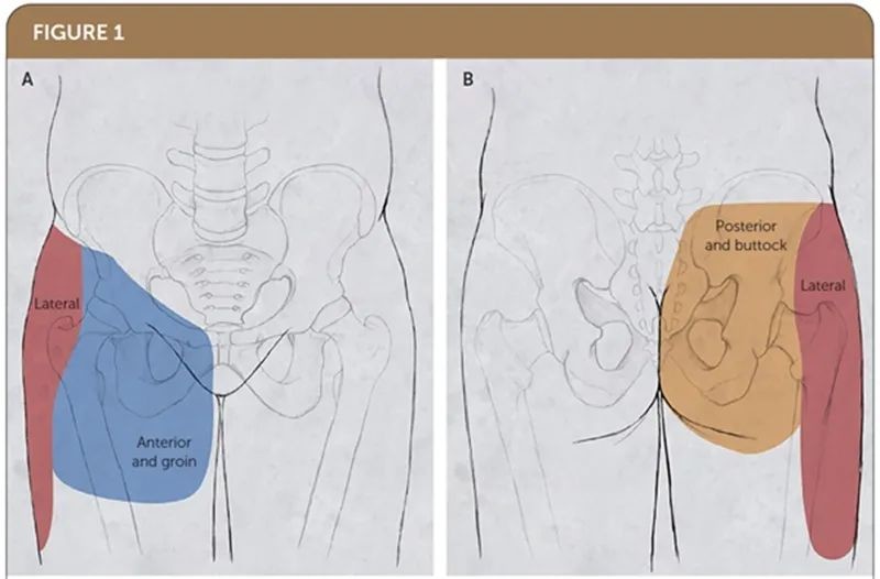 圖1.髖關節疼痛的定位.(a)前方圖示.(b)後方圖示.表1圖2.