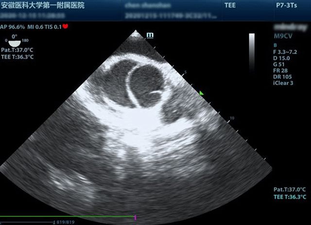 图1 术中tee检查10:55超声引导下右颈内静脉穿刺并置管