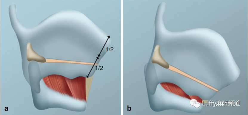 图文宝藏必收贴 儿童气道知多少 医学界 助力医生临床决策和职业成长 图文宝藏必收贴 儿童气道知多少 医学界 助力医生临床决策和职业成长