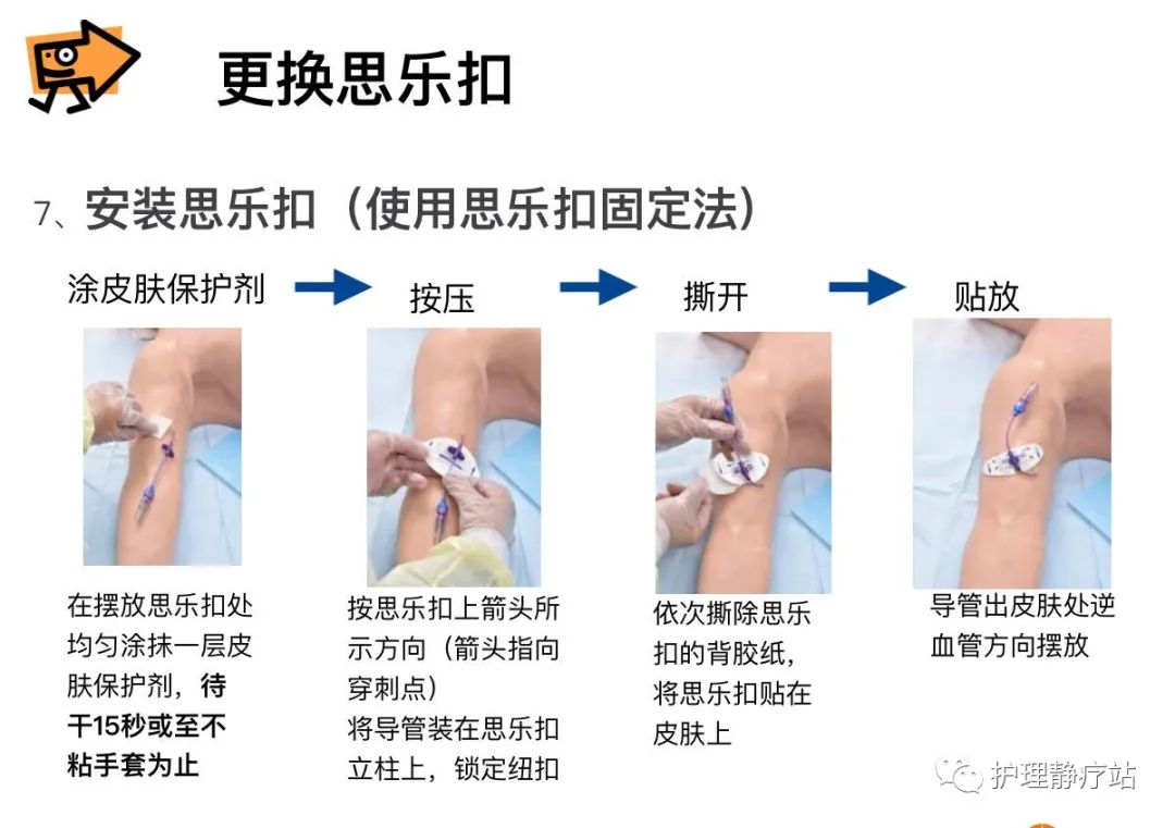 picc蝶形固定方法图片图片