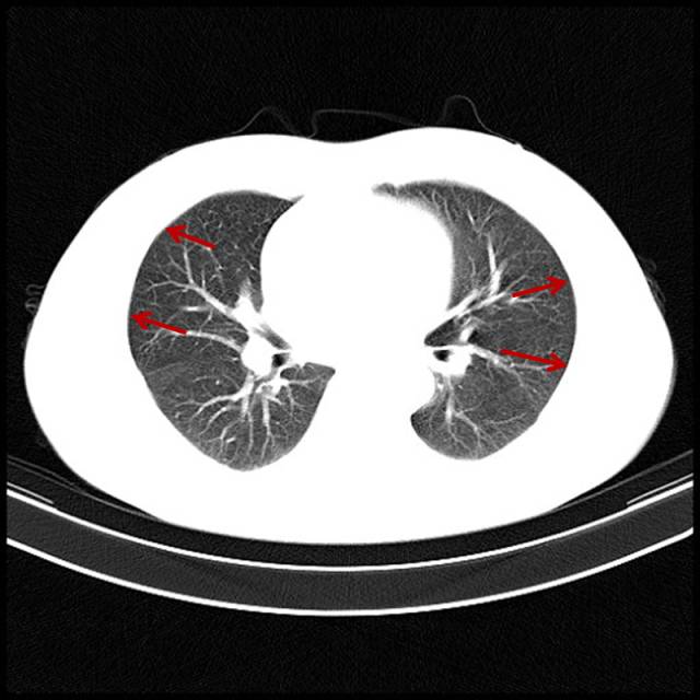 扒一扒临床常见的气胸_医学界-助力医生临床决策和职业成长
