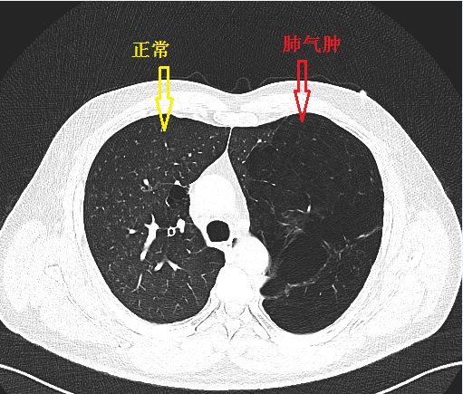 肺气肿的症状图片