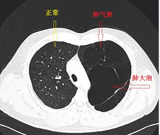 正常的肺和肺气肿图片图片