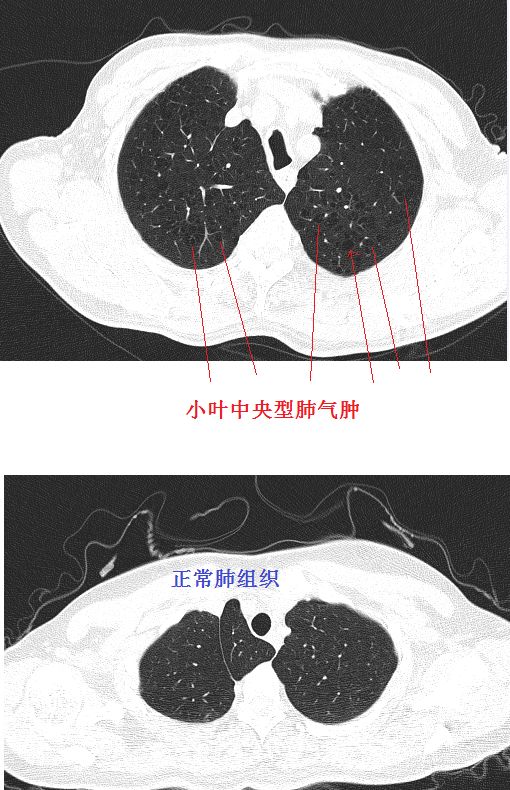 肺气肿胸片图解图片