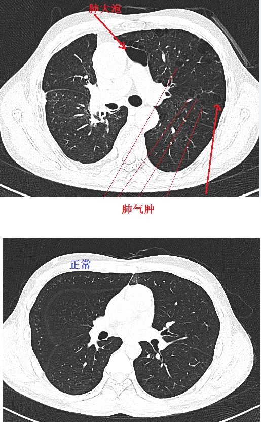 正常的肺和肺气肿图片图片