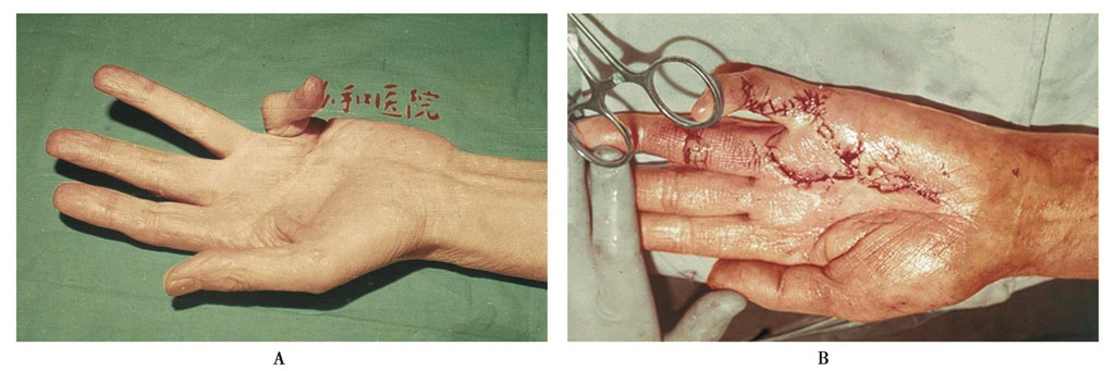 掌腱膜挛缩症原则上应早期治疗,此时手术较为简单,手术后手部功能可