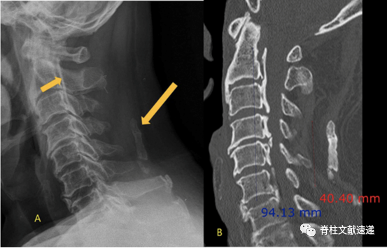 颈椎侧位x线片中易忽视的重要征象