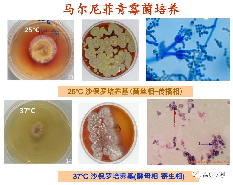 病例:发热,腹痛,mngs确诊胃肠道马尔尼菲篮状菌感染