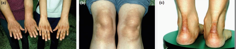 皮肤变黑 不一定是晒的 这个原因你可能想不到 医学界 助力医生临床决策和职业成长