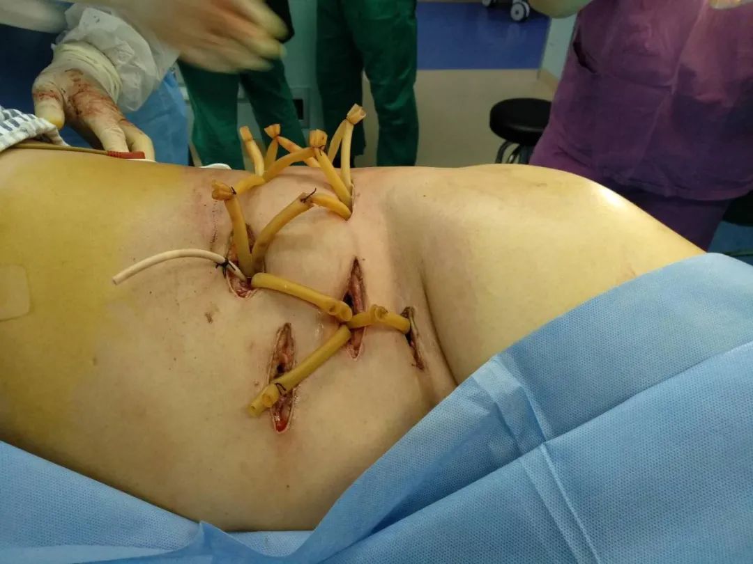 肛周脓肿术后10天图片图片
