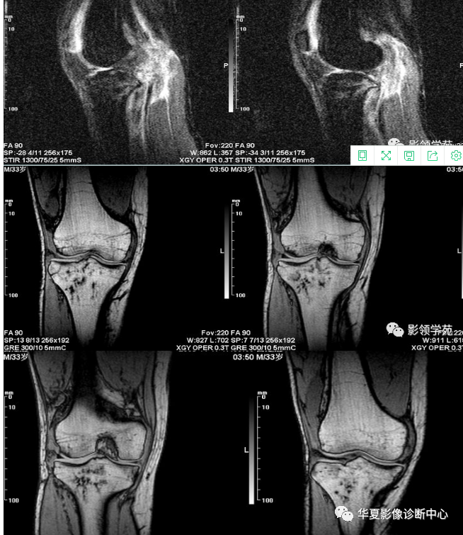 隐性骨折 骨挫伤 影像表现 医学界 助力医生临床决策和职业成长
