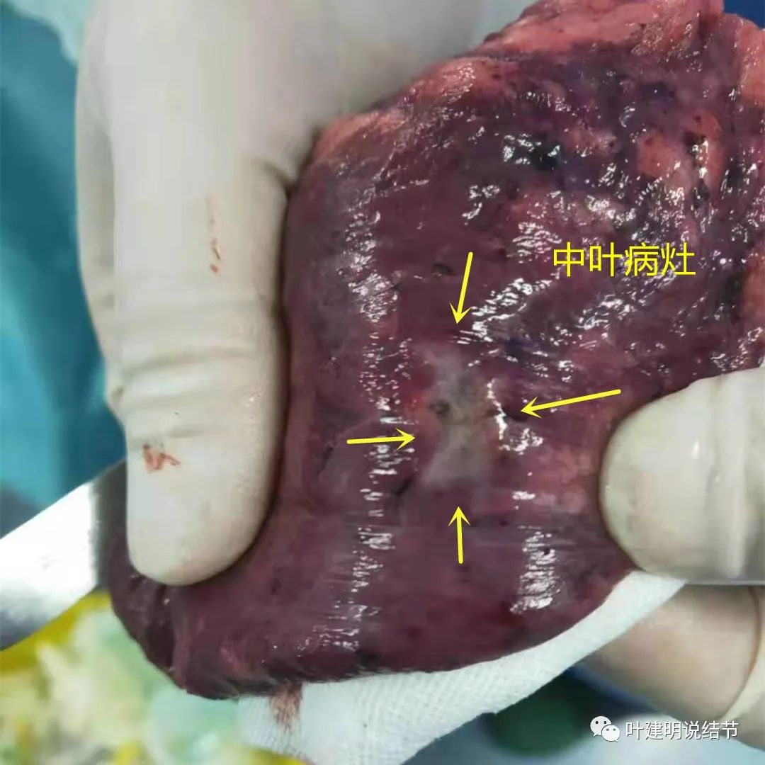 影像剖析:肺结节良恶性辨别典型病例分享_医学界-助力医生临床决策和