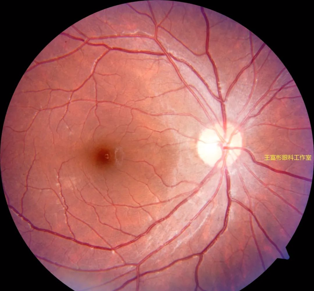 【图片赏析】五种眼底成像下的视网膜脱落_黄斑_病变_诊断