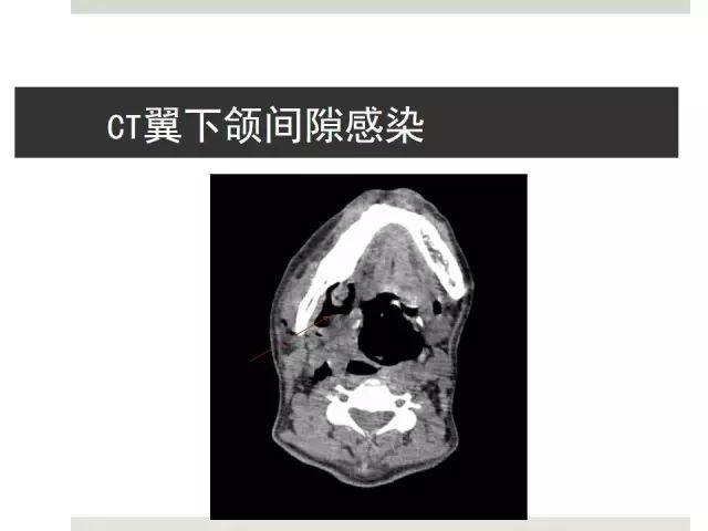 翼下颌间隙感染图片图片