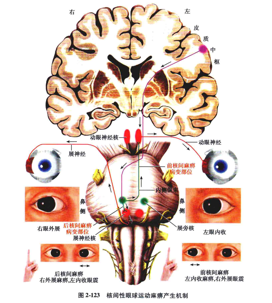 (1)前型(中腦型)核間性眼肌麻痺(圖 2-124):病灶位於內側縱束上段或中