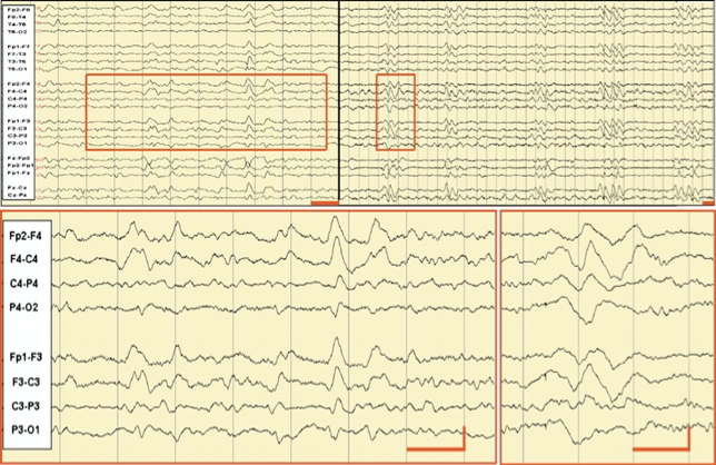 认识克雅氏病的脑电图表现