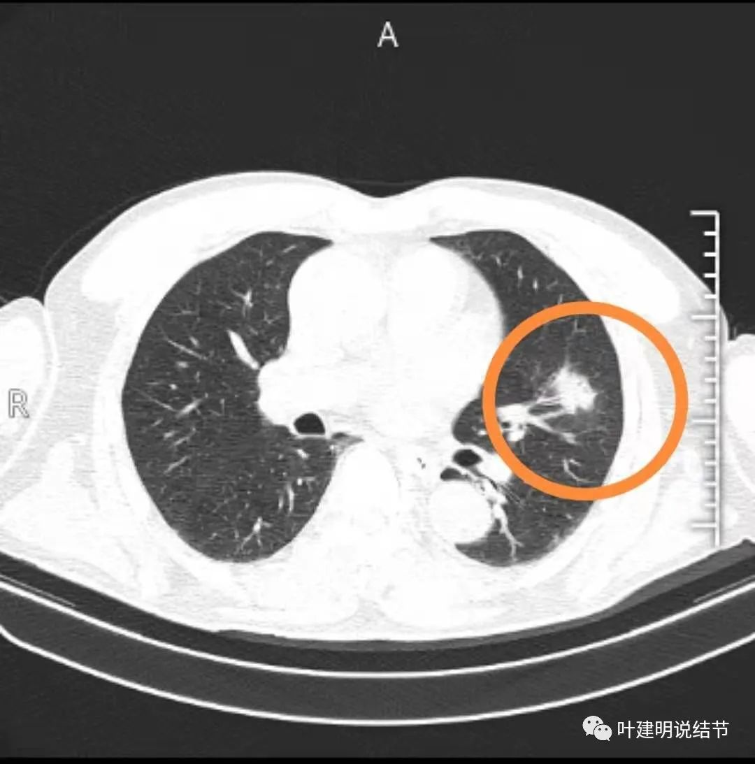 毛刺征,但实性阴影中不是很致密,前侧血管略有影响病灶似有浅分叶征左