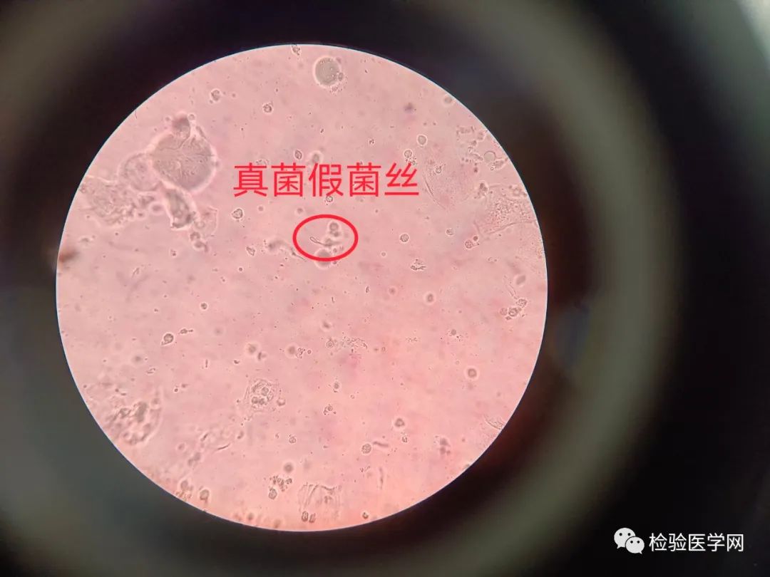 极其少见,阴道滴虫合并霉菌如何治疗?