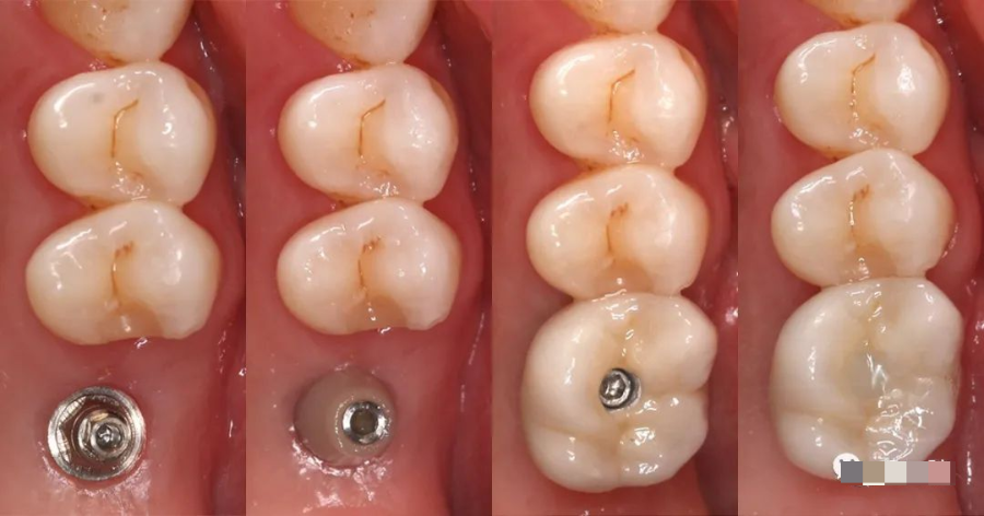 種植牙修復過程中常出現的併發症及其處理_醫學界-助力醫生臨床決策和