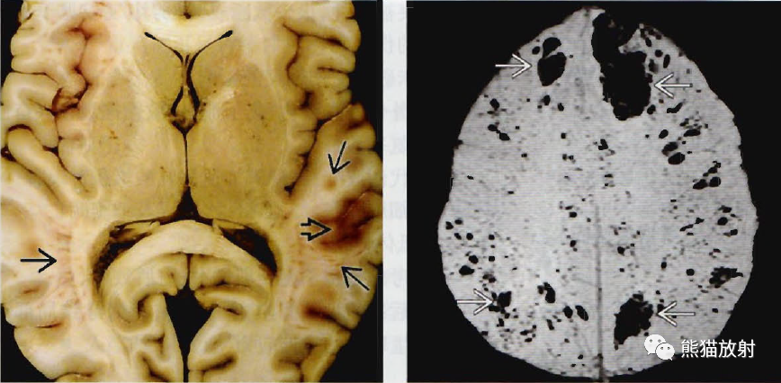 外伤性蛛网膜下腔出血脑挫伤弥漫性轴索损伤