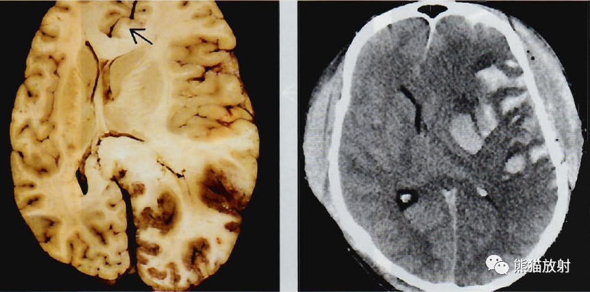 脑疝,脑死亡丨影像及临床诊断要点