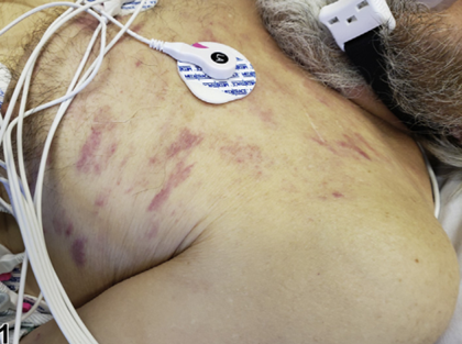 形状不规则,压之不褪色,可见局部毛细血管扩张(图1)