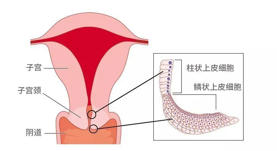 宫颈病变演变图图片