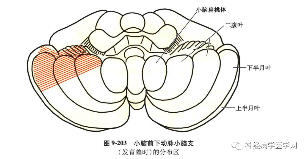 易誤診為前庭周圍性疾病的小腦前下動脈梗死一文讀懂