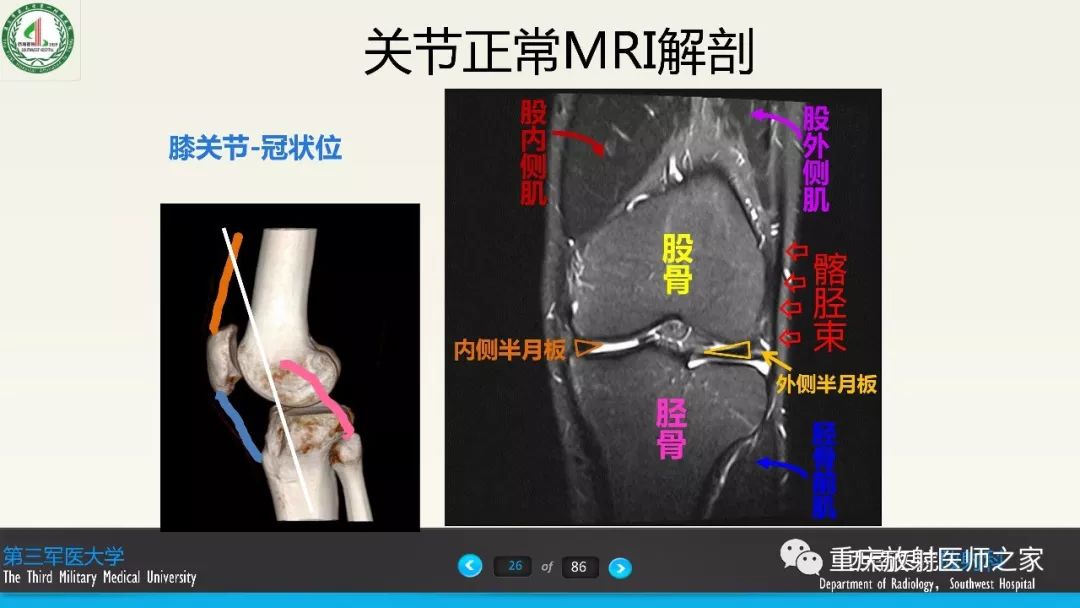 图文详解膝关节韧带的解剖及诊断