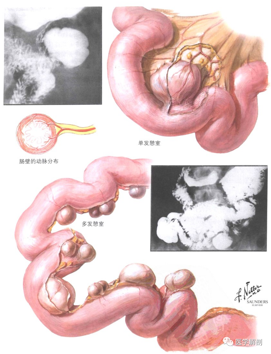 奈特解剖图谱 | 消化道憩室