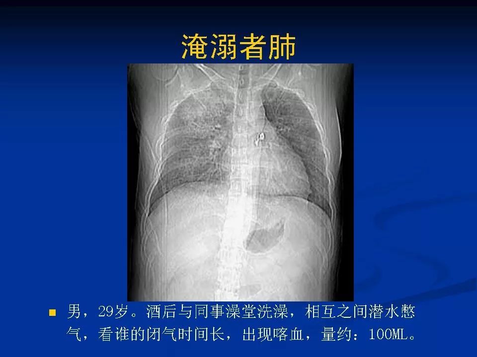 這個病太容易誤診為肺炎了