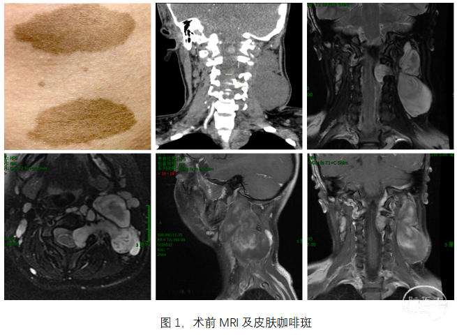 万经海教授:头颈部椎管内外沟通神经纤维瘤病i型一例