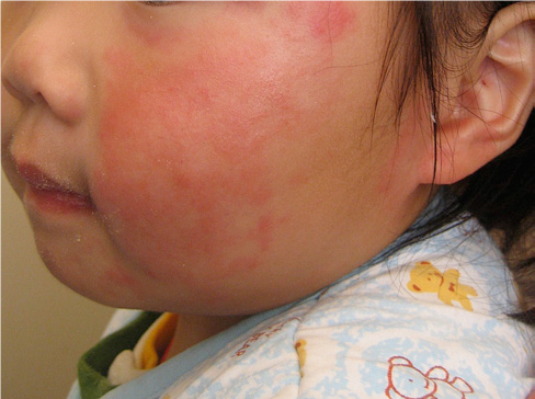 儿童过敏性皮炎 皮疹图片