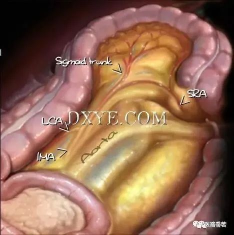 腹腔镜下乙状结肠切除术