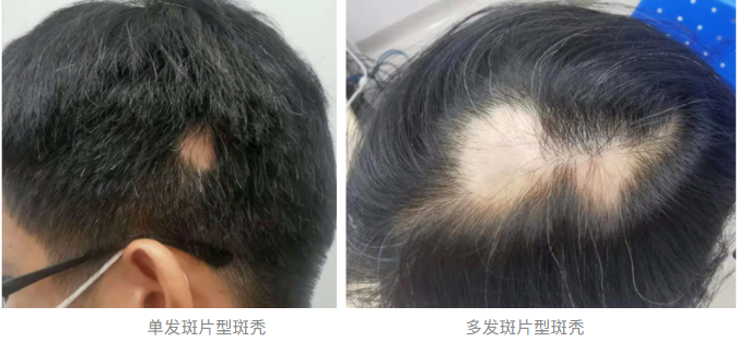 斑秃转成重症后她放弃了升职的机会